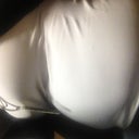This is at 10 or 12 lbs weight loss since the surgery, this is also the side with the big bulge under my rib cage