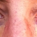 Day 1 - 2 hours after surgery