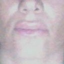 After Dermal Filler