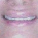 After dermal filler