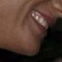 The sides of my lips ended up very thin with a big bump in the middle. Looked worse in person. Awkward. Not a natural look at all and certainly not prettier.