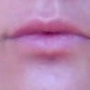 Whew! After Hyaluronidase my lips are back to normal! :)