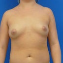 Ok... see how uneven my boobs and nipples were before?  Then check out my after photo- I just asked Dr. S's office to send me my before because I must have deleted the pictures I took for my first email/phone consult. My nipples actually match now!