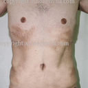 Male Tummy Tuck