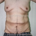 Male Tummy Tuck