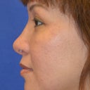 Asian Rhinoplasty, Augmentation With Cartilage