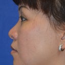 Asian Rhinoplasty, Augmentation With Cartilage