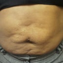 Picture months before surgery