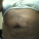 Picture months before surgery