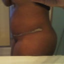Had a Seroma here!!!Picture before having 450-600cc of fluid drawn from my stomach @ 4 weeks post op