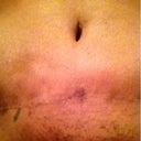 one year picture of scar from front