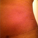One year pic of scar form the right side