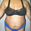 I look better with clothes. I promise. (pre-op)