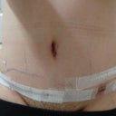 14 DPO please ignore the paper tape above, it was used to tape a gauge on it for comfort, notice the scar looking thing above the incision, found out i was allergic to surgical plastic tape.