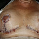 Sat 2 June Post-op day 1