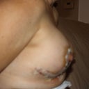 Post-op day 3