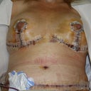 Mon 4 June Post-op day 4 at the PS office....first time I've seen my tummy he said it is swollen but looks great.  By Fri 8 I will be able to shower without the cg on...can't wait!!!