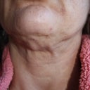 6 weeks after Surgery