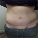 7 WEEKS POST OP Front: scar healing well. infection gone.