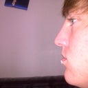 After - Close up of left side : 1 Hour later