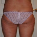 Pre-op of thighs