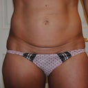 Front view pre surgery