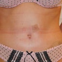 14 days post op