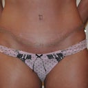 6 weeks post op showing scar