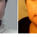 2 months post op-front