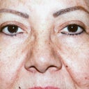 Upper Blepharoplasty