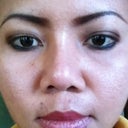 6 weeks after surgery, my nostril uneven