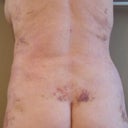 Back 1 week after surgery bruised swollen