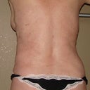 Swelling is leaving in the bra back area. I was kind of concerned thinking there might be loose skin hanging after the swelling left but looks good.