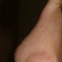 The bump at the top of the bridge is an ear cartilage graft.