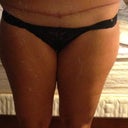 Scar at 4 months post op