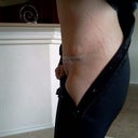 Post op day 1