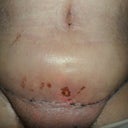 1 week post op.  Not so pretty :(