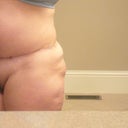 after..dents everywhere, big chunk missing out of R but/hip, major nerve damage, pain and no change to stomach muscles for big scar.