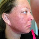 1 hour after procedure- fee no pain or heat