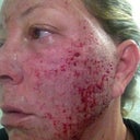 10 hours after- sweating blood, scary looking but no pain