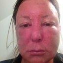 morning of day 2- extreme swelling. uncomfortable to smile or open mouth