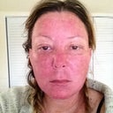 day 3 evening- slough skin off- have been using apple cider vinegar at 2- 4 hr intervals since day 1 followed by aquafor.