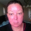 Morning of Day 4. 80% of laser skin has come off.