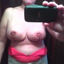13 days post-op