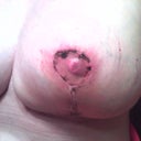 My left nipple that gave the Dr. so much trouble.  The pictures don't look good but it actually is doing great.
