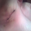 Right under arm incision.