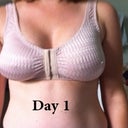 Day 1 with surgical bar on