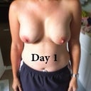 Day 1 no bra - very swollen and sitting high