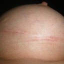 Right Breast Day 38