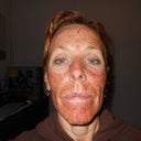 This is 17 hours post procedure.